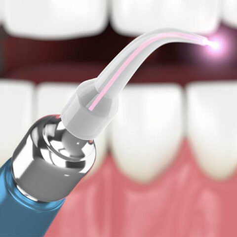 laser dentistry tool